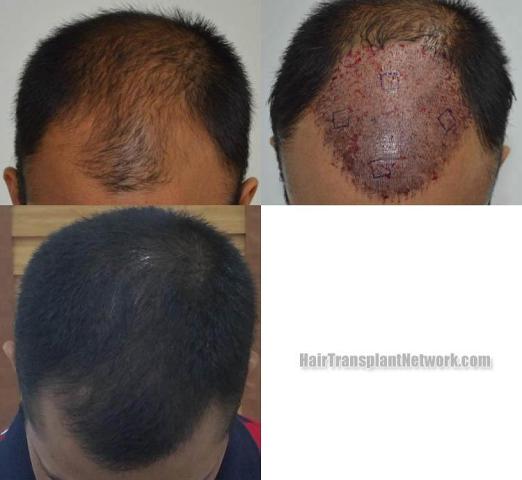 Hair transplantation surgery before and after photos