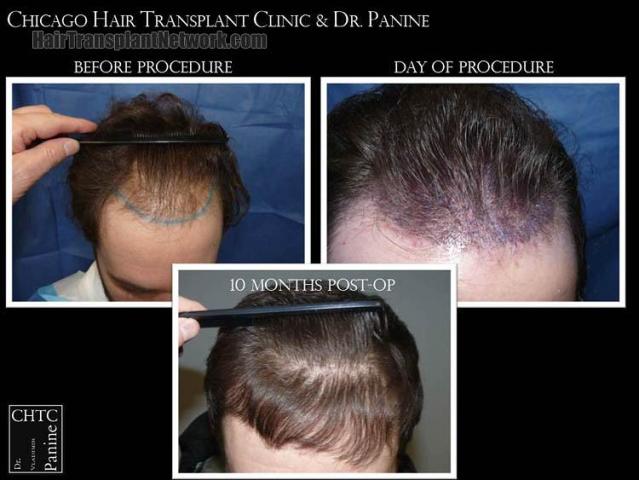 Hair restoration procedure before and after results