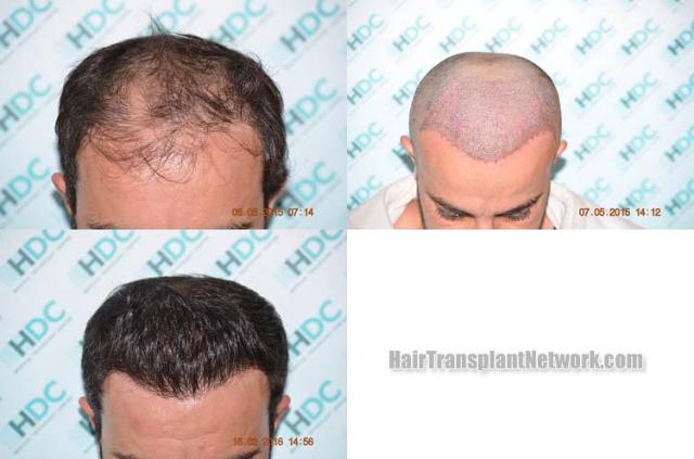 Hair transplantation surgery before and after photos