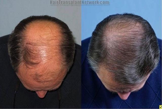 Hair restoration procedure before and after results