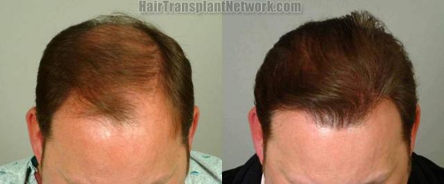 Hair transplantation surgery before and after images