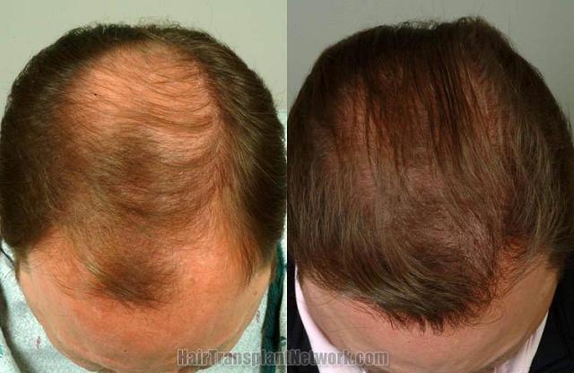 Hair restoration procedure before and after results