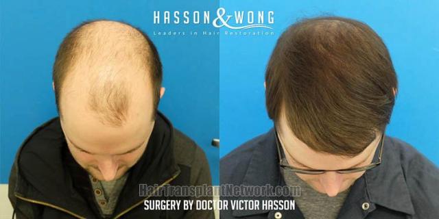 Before and after hair transplant procedure images