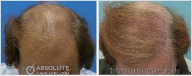 Hair restoration procedure before and after result photos