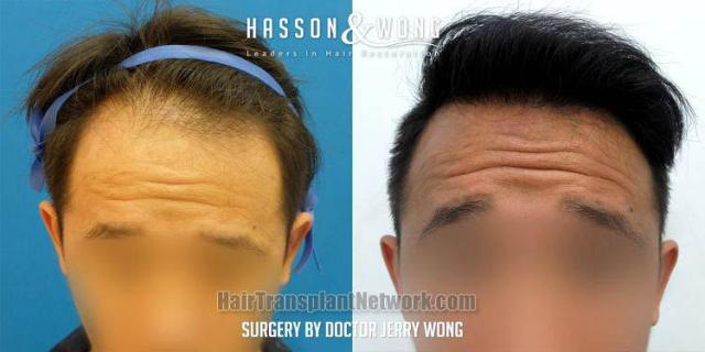 Hair transplantation surgery before and after images