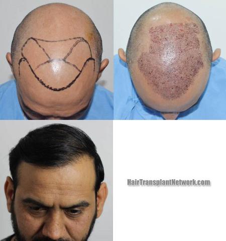 Hair transplantation surgery before and after images