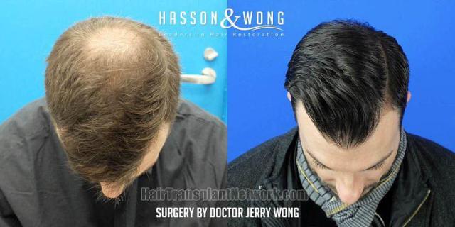 Hair transplantation surgery before and after images