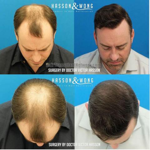 Top view - Before and after hair restoration procedure