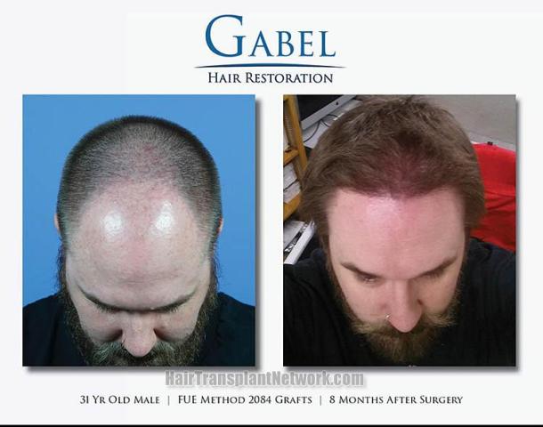 Top view - Before and after hair restoration procedure