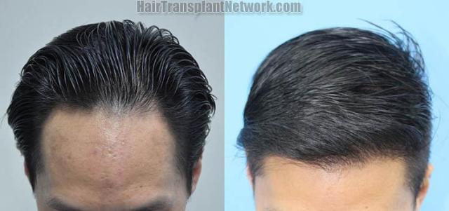 Before and after hair restoration procedure images