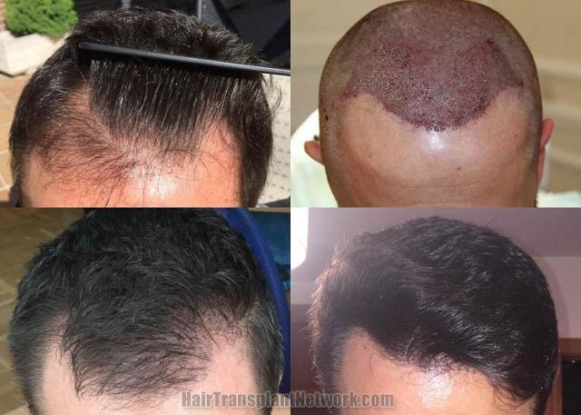 Top view - Before and after hair restoration procedure