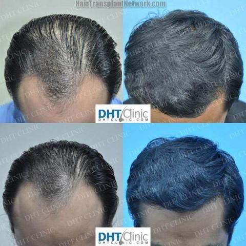 Hair transplantation surgery before and after images