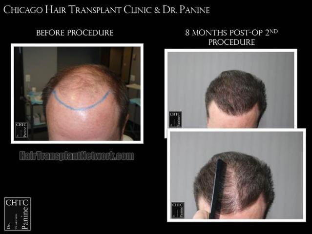 Hair transplantation surgery before and after images