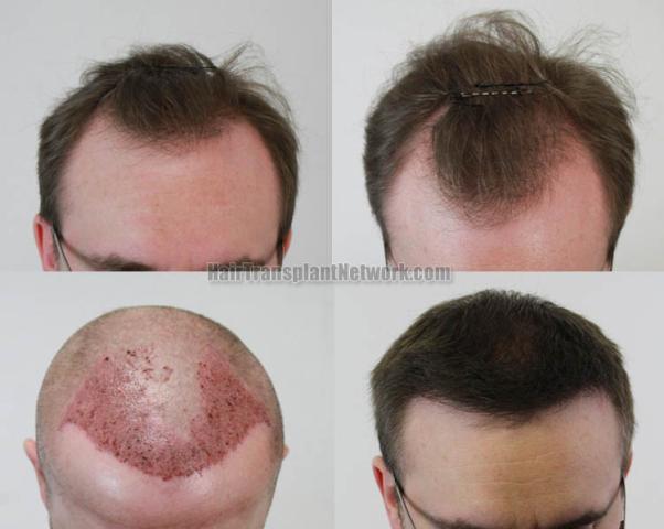 Hair transplantation surgery before and after images