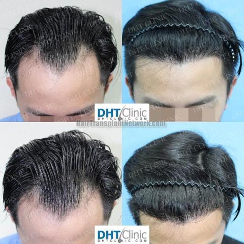 Hair transplantation procedure before and after results