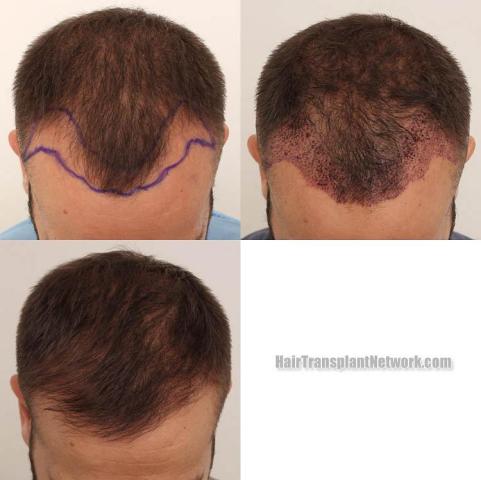 Before and after hair restoration procedure images