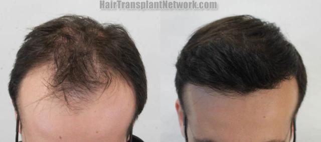 Before and after hair restoration procedure images