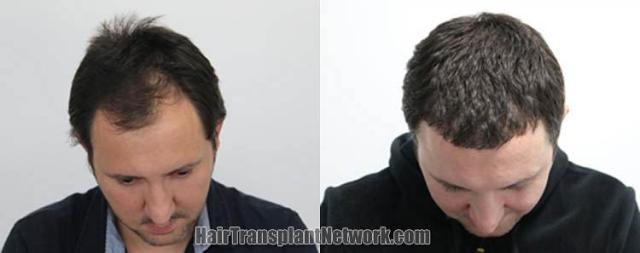 Before and after hair restoration procedure images