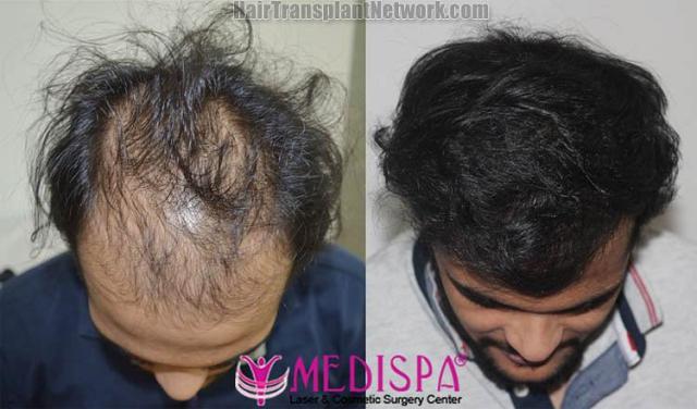 Before and after hair restoration procedure images