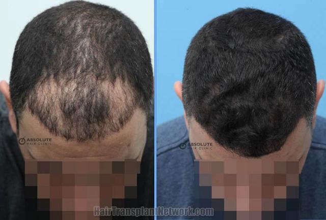 Before and after hair restoration procedure images