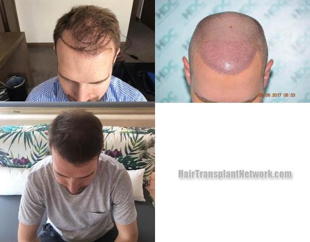 Hair transplantation surgery before and after images