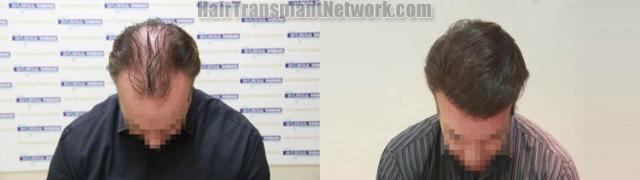 Hair transplantation surgery before and after photos