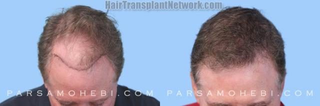 Hair restoration procedure before and after results