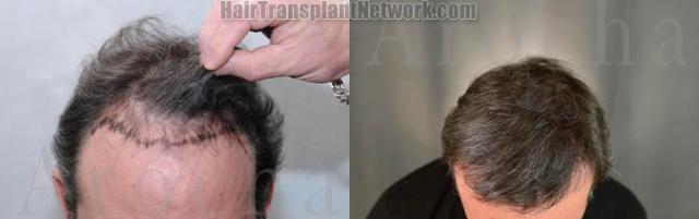 Hair transplantation surgery before and after photos