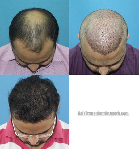 Hair restoration procedure before and after results