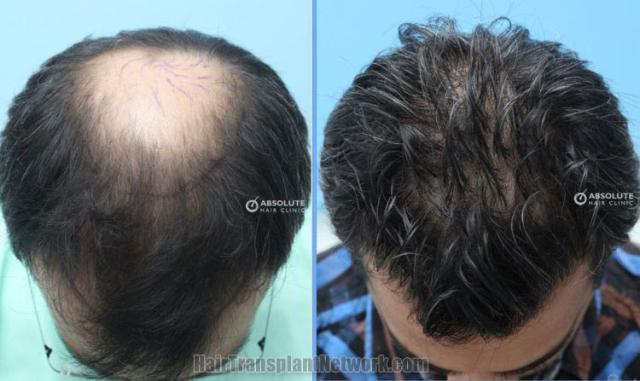 Hair transplantation surgery before and after images