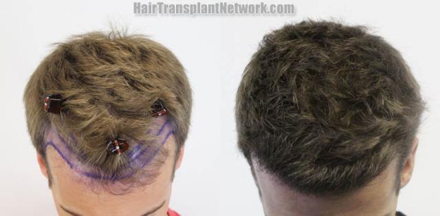 Hair transplantation surgery before and after images