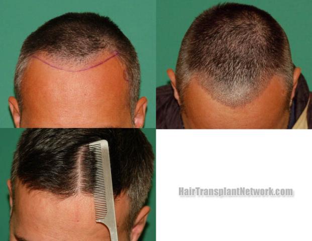 Hair restoration procedure before and after results