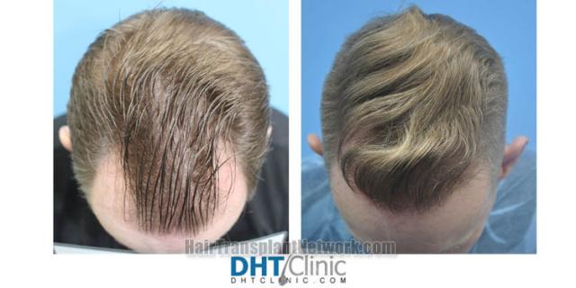 Hair transplantation surgery before and after images