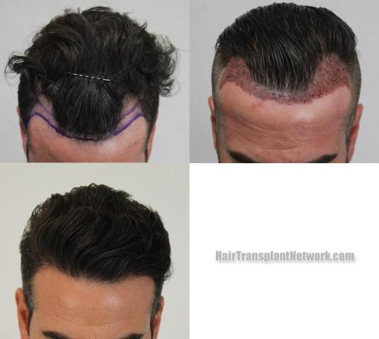 Hair transplantation surgery before and after images