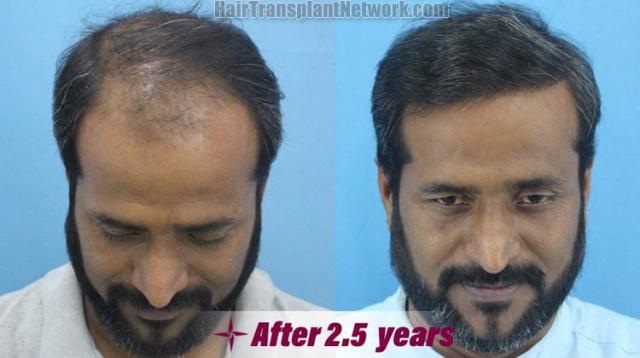 Hair transplantation surgery before and after images