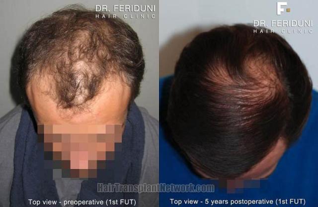 Hair transplantation surgery before and after pictures