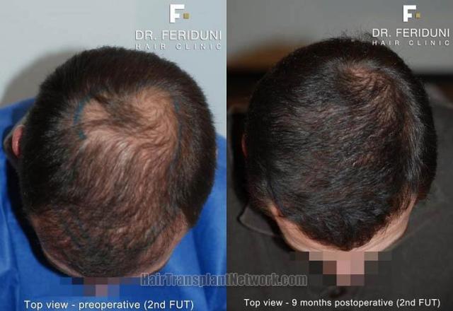 Hair restoration surgery before and after images