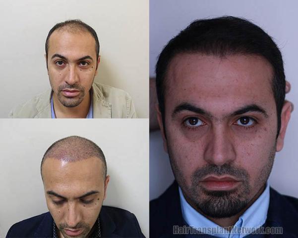 Hair transplantation surgery before and after images