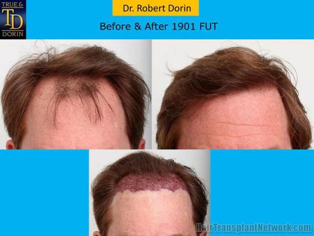 Hair transplantation surgery before and after photos