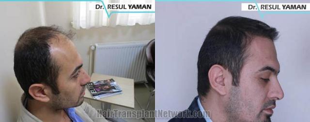 Hair restoration procedure before and after pictures