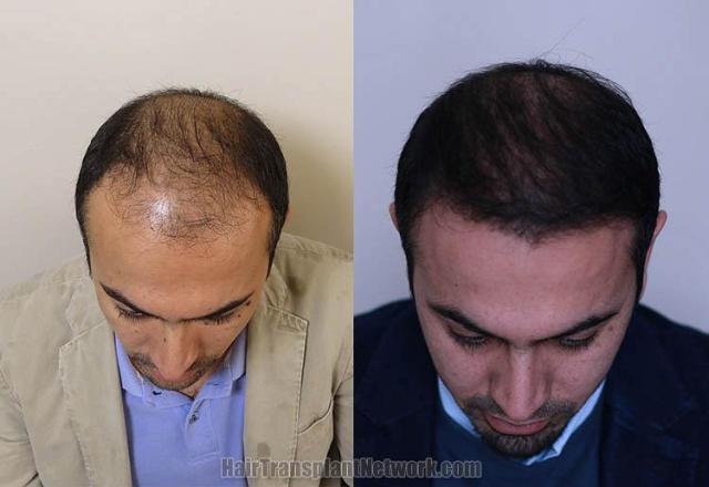 Hair transplantation surgery before and after pictures