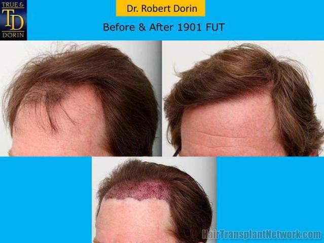 Hair restoration procedure before and after pictures