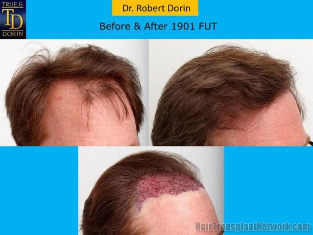 Hair transplantation surgery before and after pictures