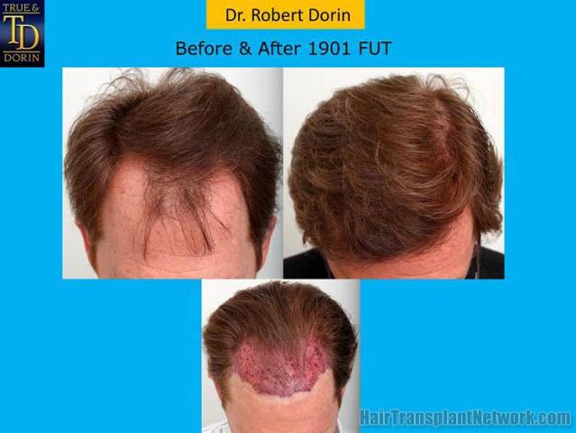 Hair transplantation surgery before and after images