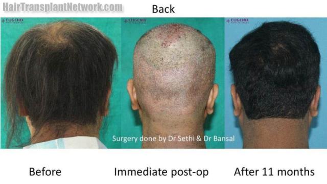 Surgical hair transplantation result photographs