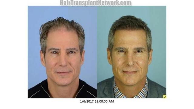 Front view - Before and after hair transplantation surgery