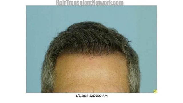 Hair restoration surgery before and after pictures