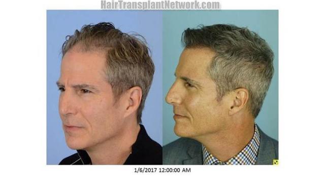 Hair restoration procedure before and after pictures