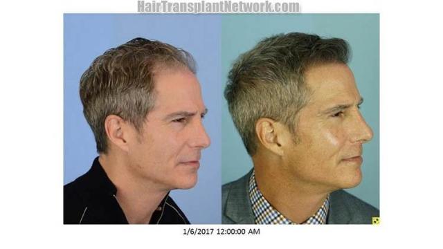 Hair transplantation surgery before and after images