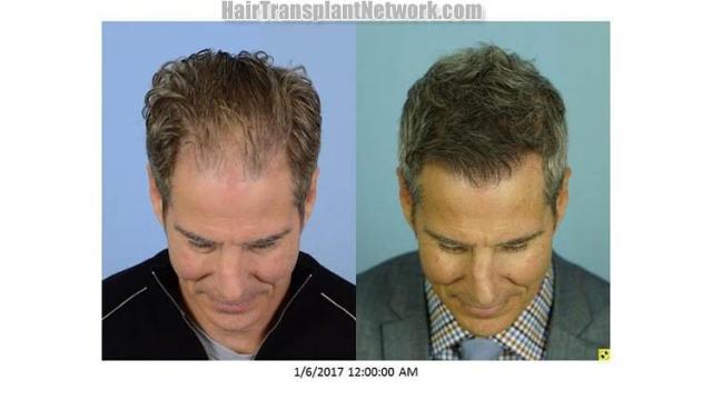 Hair restoration procedure before and after photo results